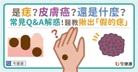 痣 凸起來|是痣？皮膚癌？還是什麼？常見Q&A解惑！醫教揪出「。